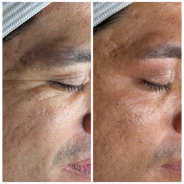 Microchanneling (Face) Series of 9 at Salt + Light Skincare in Atascocita, TX