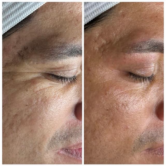 Microchanneling (Face) Series of 3 at Salt + Light Skincare in Atascocita, TX