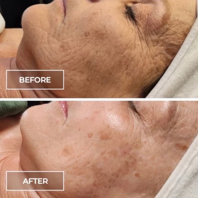 SWiCH Series of 9 at Salt + Light Skincare in Atascocita, TX